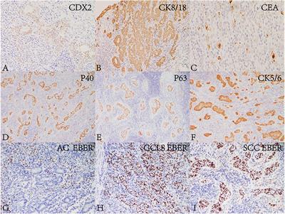 Case report: Gastric adenosquamous carcinoma with EBV-positive component of squamous cell carcinoma mixed with gastric carcinoma with lymphoid stroma: A novel case report and literature review